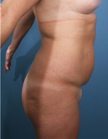 Liposuction Before Photo by Marvin Shienbaum, MD; Brandon, FL - Case 30900