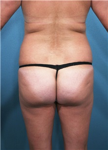 Liposuction Before Photo by Marvin Shienbaum, MD; Brandon, FL - Case 30900