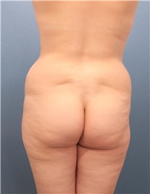 Liposuction Before Photo by Marvin Shienbaum, MD; Brandon, FL - Case 30901