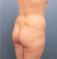 Liposuction Before Photo by Marvin Shienbaum, MD; Brandon, FL - Case 30901