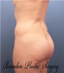 Liposuction After Photo by Marvin Shienbaum, MD; Brandon, FL - Case 30901