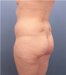 Liposuction Before Photo by Marvin Shienbaum, MD; Brandon, FL - Case 30901