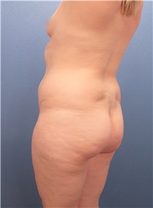 Liposuction Before Photo by Marvin Shienbaum, MD; Brandon, FL - Case 30913