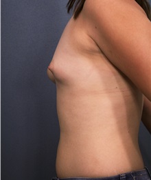 Breast Augmentation Before Photo by Marvin Shienbaum, MD; Brandon, FL - Case 31188