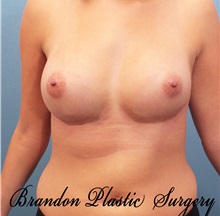 Breast Augmentation After Photo by Marvin Shienbaum, MD; Brandon, FL - Case 31189