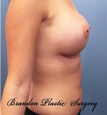 Breast Augmentation After Photo by Marvin Shienbaum, MD; Brandon, FL - Case 31189