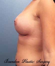 Breast Augmentation After Photo by Marvin Shienbaum, MD; Brandon, FL - Case 31189