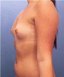 Breast Augmentation Before Photo by Marvin Shienbaum, MD; Brandon, FL - Case 31189