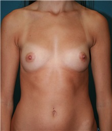 Breast Augmentation Before Photo by Marvin Shienbaum, MD; Brandon, FL - Case 31192