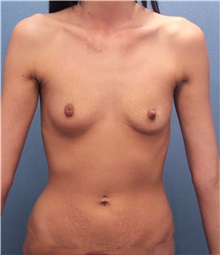 Breast Augmentation Before Photo by Marvin Shienbaum, MD; Brandon, FL - Case 31194