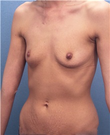 Breast Augmentation Before Photo by Marvin Shienbaum, MD; Brandon, FL - Case 31194