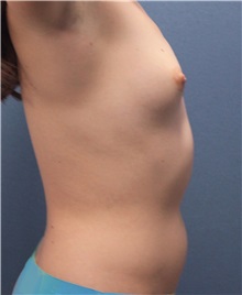 Breast Augmentation Before Photo by Marvin Shienbaum, MD; Brandon, FL - Case 31195