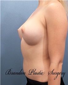 Breast Augmentation After Photo by Marvin Shienbaum, MD; Brandon, FL - Case 31195