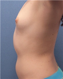 Breast Augmentation Before Photo by Marvin Shienbaum, MD; Brandon, FL - Case 31195