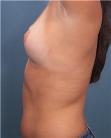 Breast Augmentation Before Photo by Marvin Shienbaum, MD; Brandon, FL - Case 31196