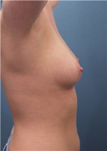 Breast Augmentation Before Photo by Marvin Shienbaum, MD; Brandon, FL - Case 31197