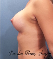 Breast Augmentation After Photo by Marvin Shienbaum, MD; Brandon, FL - Case 31199