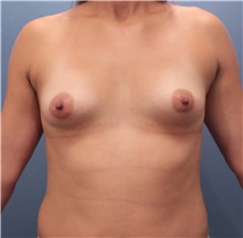 Breast Augmentation Before Photo by Marvin Shienbaum, MD; Brandon, FL - Case 31199