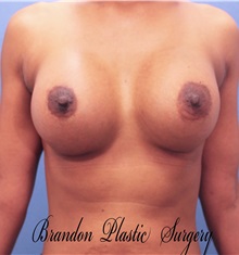 Breast Augmentation After Photo by Marvin Shienbaum, MD; Brandon, FL - Case 31205