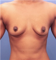 Breast Augmentation Before Photo by Marvin Shienbaum, MD; Brandon, FL - Case 31205