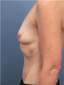 Breast Augmentation Before Photo by Marvin Shienbaum, MD; Brandon, FL - Case 31208