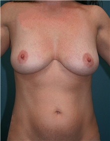 Breast Augmentation Before Photo by Marvin Shienbaum, MD; Brandon, FL - Case 31209