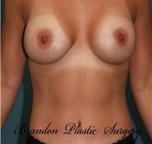 Breast Augmentation After Photo by Marvin Shienbaum, MD; Brandon, FL - Case 31225