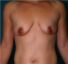 Breast Augmentation Before Photo by Marvin Shienbaum, MD; Brandon, FL - Case 31225