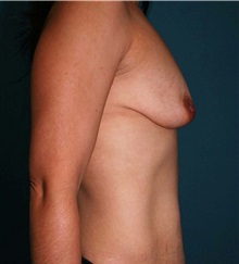 Breast Augmentation Before Photo by Marvin Shienbaum, MD; Brandon, FL - Case 31225