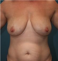 Breast Augmentation Before Photo by Marvin Shienbaum, MD; Brandon, FL - Case 31226