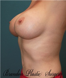 Breast Augmentation After Photo by Marvin Shienbaum, MD; Brandon, FL - Case 31226