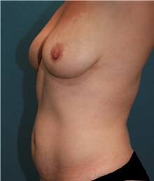 Breast Augmentation Before Photo by Marvin Shienbaum, MD; Brandon, FL - Case 31226