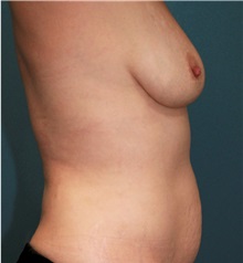 Breast Augmentation Before Photo by Marvin Shienbaum, MD; Brandon, FL - Case 31226