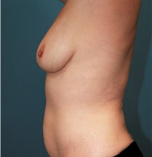 Breast Augmentation Before Photo by Marvin Shienbaum, MD; Brandon, FL - Case 31226