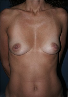 Breast Augmentation Before Photo by Marvin Shienbaum, MD; Brandon, FL - Case 31231