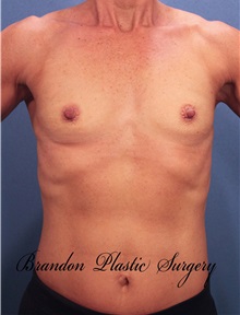 Breast Augmentation Before Photo by Marvin Shienbaum, MD; Brandon, FL - Case 31232