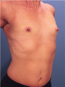 Breast Augmentation Before Photo by Marvin Shienbaum, MD; Brandon, FL - Case 31232