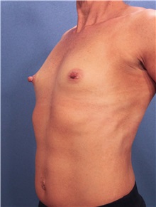 Breast Augmentation Before Photo by Marvin Shienbaum, MD; Brandon, FL - Case 31232