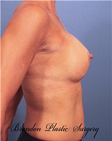 Breast Augmentation After Photo by Marvin Shienbaum, MD; Brandon, FL - Case 31232