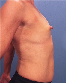 Breast Augmentation Before Photo by Marvin Shienbaum, MD; Brandon, FL - Case 31232