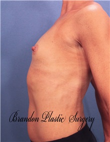 Breast Augmentation Before Photo by Marvin Shienbaum, MD; Brandon, FL - Case 31232