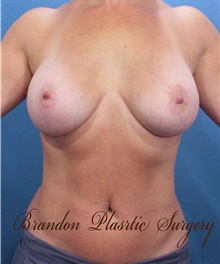 Breast Augmentation After Photo by Marvin Shienbaum, MD; Brandon, FL - Case 31233