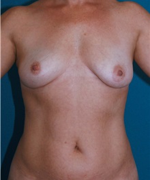 Breast Augmentation Before Photo by Marvin Shienbaum, MD; Brandon, FL - Case 31233