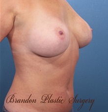 Breast Augmentation After Photo by Marvin Shienbaum, MD; Brandon, FL - Case 31233