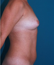 Breast Augmentation Before Photo by Marvin Shienbaum, MD; Brandon, FL - Case 31233