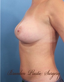 Breast Augmentation After Photo by Marvin Shienbaum, MD; Brandon, FL - Case 31233