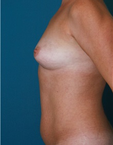 Breast Augmentation Before Photo by Marvin Shienbaum, MD; Brandon, FL - Case 31233