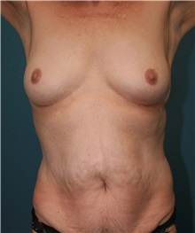 Breast Augmentation Before Photo by Marvin Shienbaum, MD; Brandon, FL - Case 31234