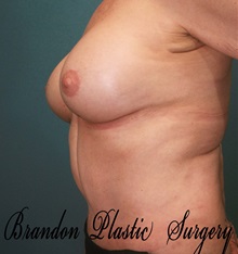 Breast Augmentation After Photo by Marvin Shienbaum, MD; Brandon, FL - Case 31234