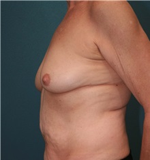 Breast Augmentation Before Photo by Marvin Shienbaum, MD; Brandon, FL - Case 31234